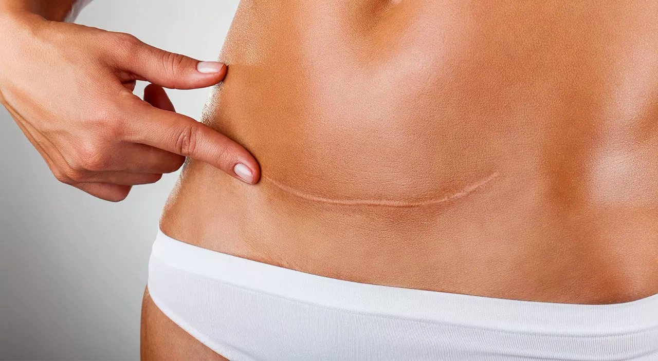 tummy-tuck-scar-revision-surgery – Cosmetic Surgery Sri Lanka. Safe,  Affordable. Experienced, Qualified & Licensed Plastic Surgeons and Dentists.